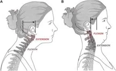 Looking straight ahead tucking in the chin for trapezius pain