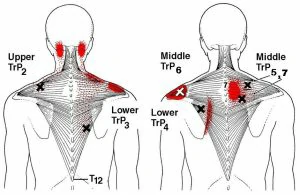 traps muscle trigger points