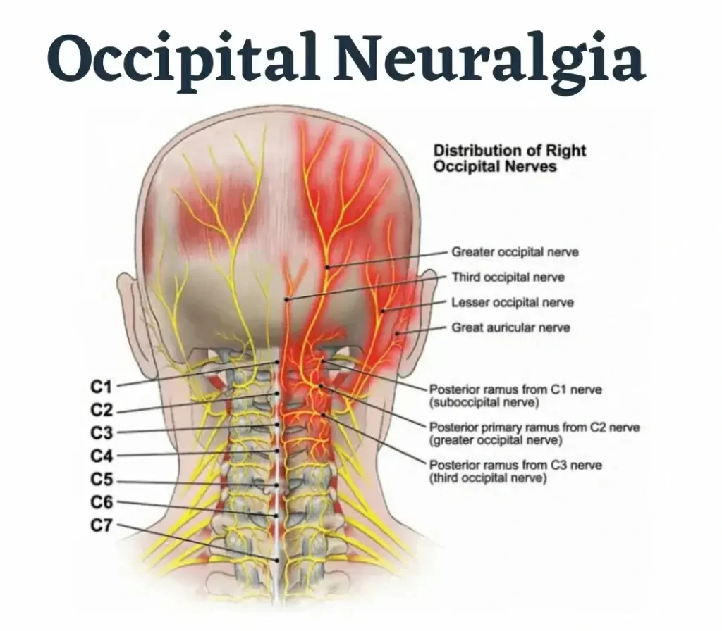 Occipital neuralgia also called Arnold's neuralgia